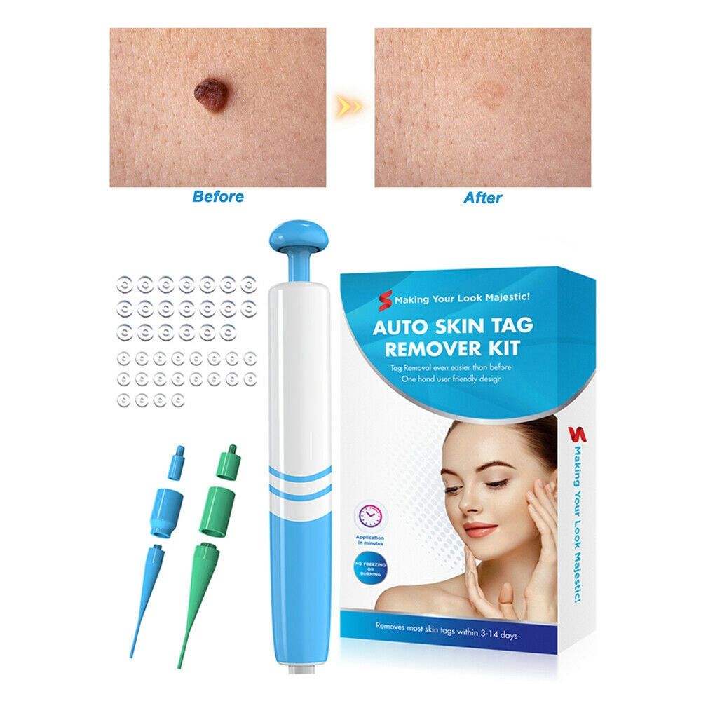 Painless Wart Removal Kit